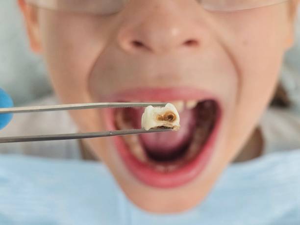 Best Emergency Dentist for Lost Fillings or Crowns in Wilmerding, PA